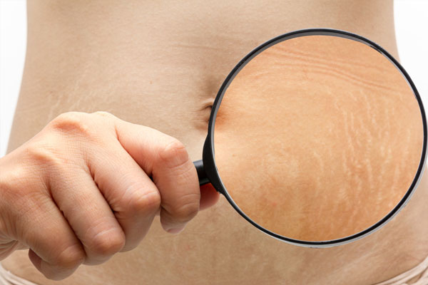 Vücuttaki Çatlaklar Artık Sorun Değil