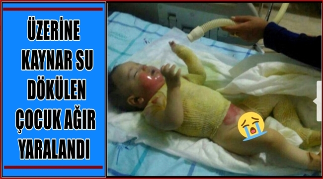 ESKİL&#039;DE ÜZERİNE KAYNAR SU DÖKÜLEN ÇOCUK AĞIR YARALANDI