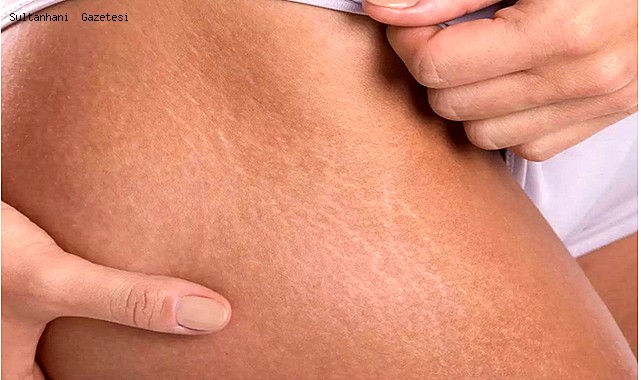 Vücuttaki Çatlaklar Artık Sorun Değil