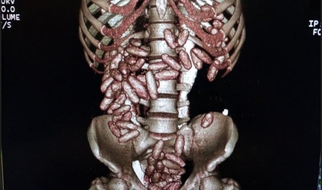 Midesindeki kokain ile yakalandı