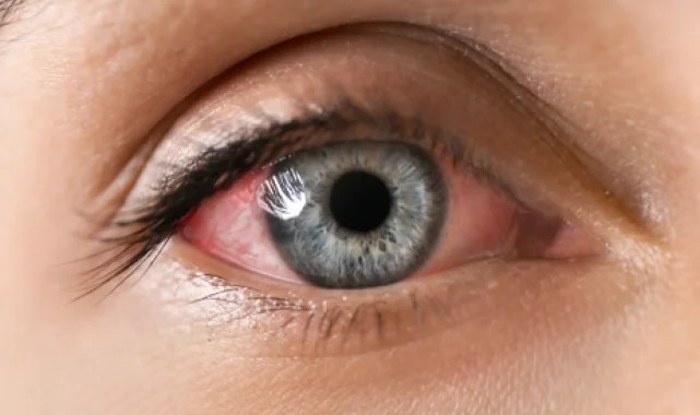 Göz enfeksiyonundan korunmanın 6 yolu