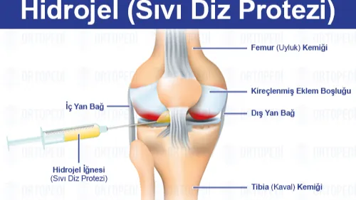 Sıvı Diz Protezi: Hidrojel ile Yeniden Hareket Kabiliyeti